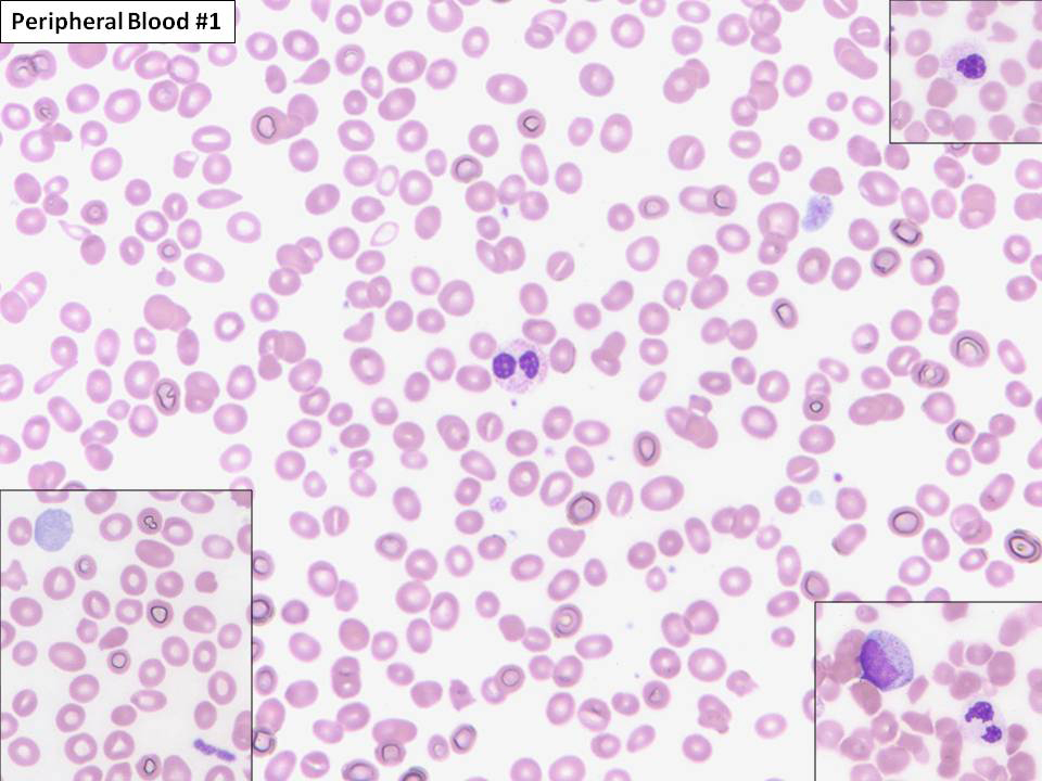 Peripheral blood #1: Peripheral blood smear at time of first bone marrow biopsy. There is red blood cell anisopoikilocytosis, and rare hypogranular neutrophils and neutrophils with pseudo-Pelger-Huet anomaly are seen. Occasional giant and hypogranular platelets are present.